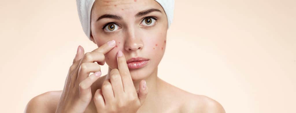 Dealing with Acne in the Teenage Years